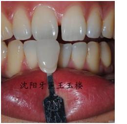 美塑小贴关闭前牙间隙--作者王玉楼