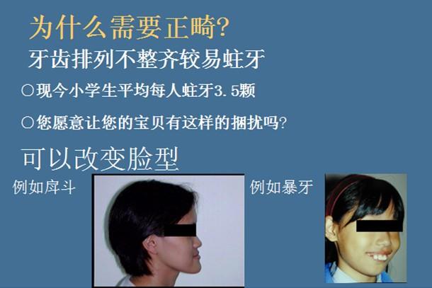 孩子前牙反颌俗称兜齿应该如何治疗