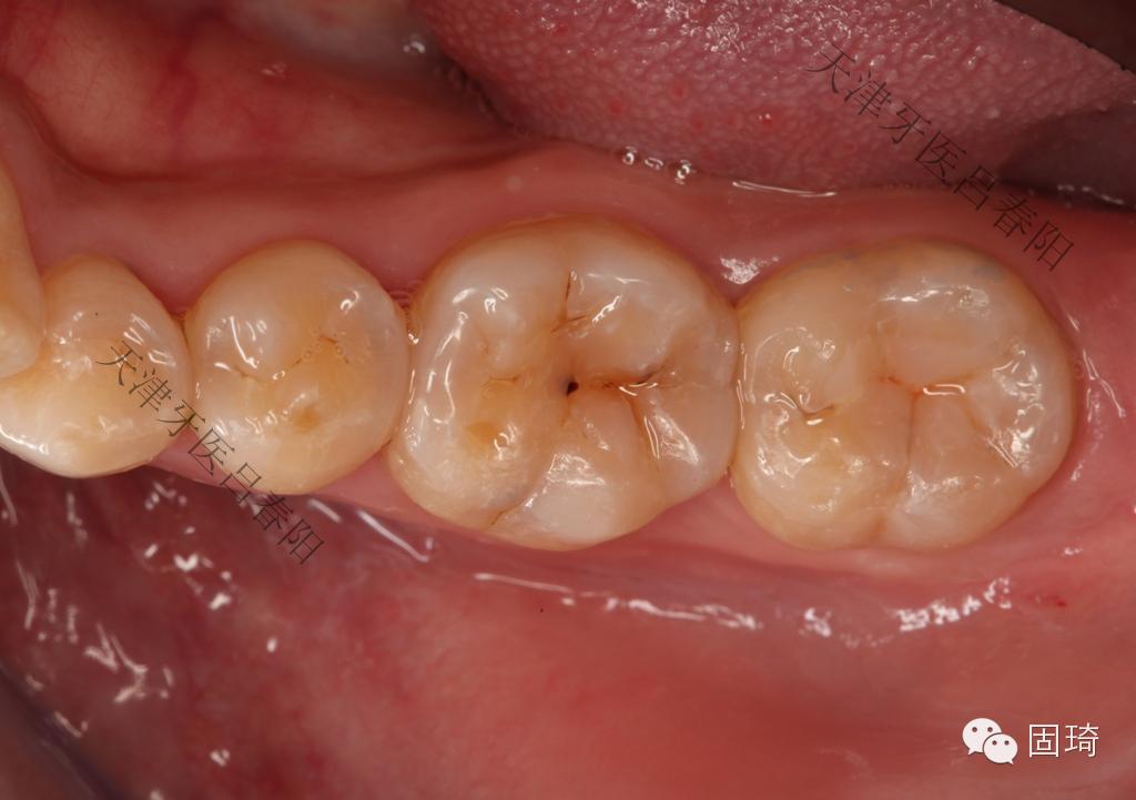 后牙意大利美学树脂充填体会—天津牙医吕春阳