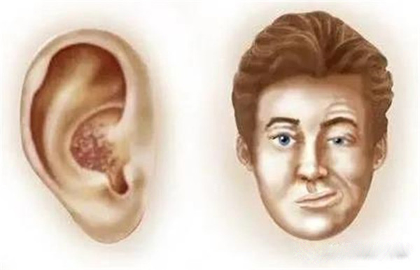 亨特综合征,又称为耳带状疱疹,约占面瘫的10%,由水痘-带状疱疹病毒