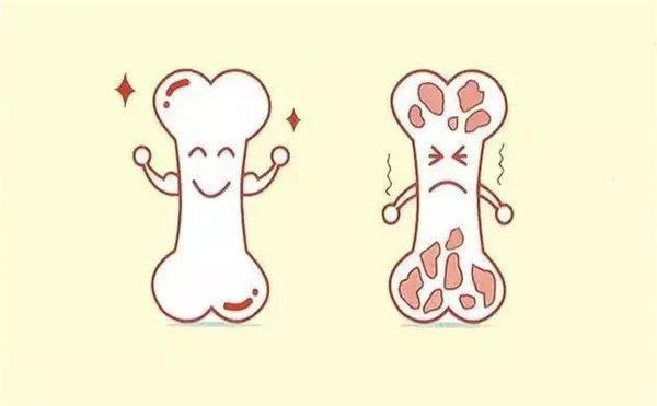 骨质疏松威胁中老年女性健康